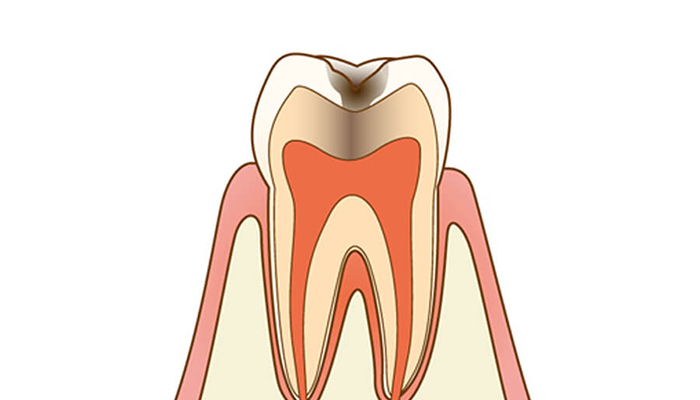 C2：感染歯質が表層のエナメル質を超え、2層目の象牙質内に入り込んだ状態