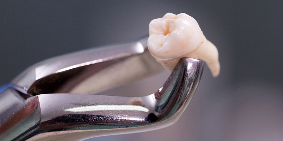 親知らずの抜歯について