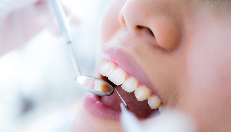 治療当日に仮歯まで装着可能