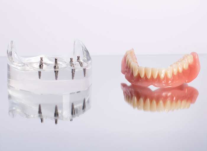 インプラントオーバーデンチャー(IDO)