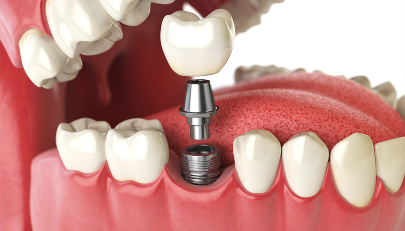 インプラント1本の場合