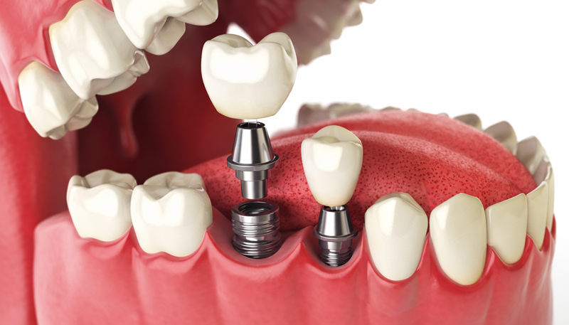 インプラント2本の場合